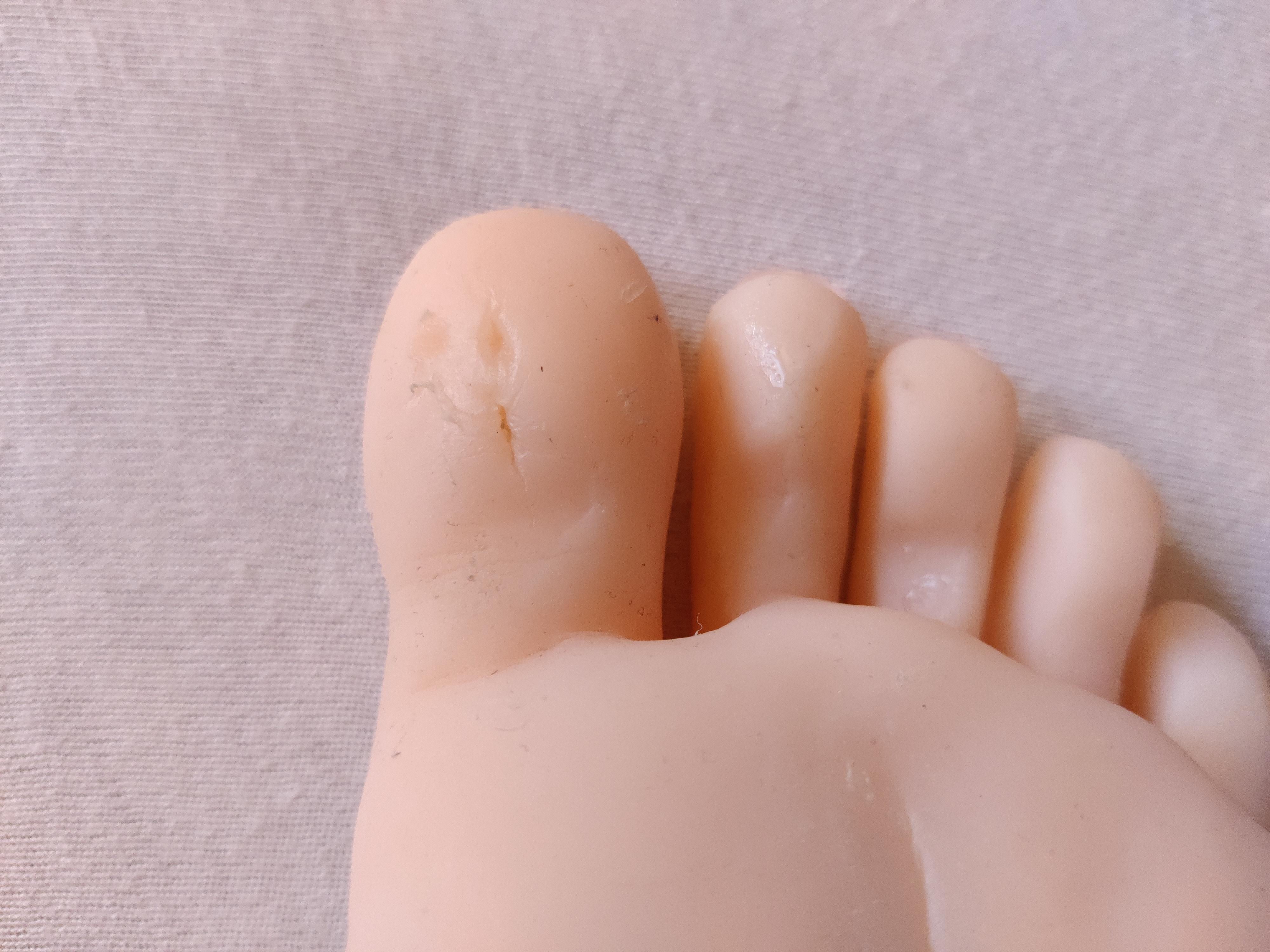 Damaged toe